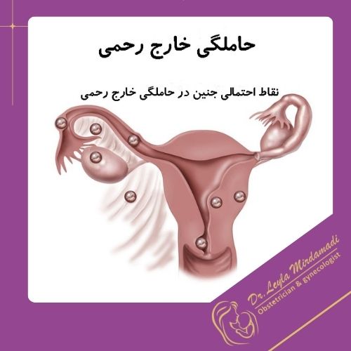 حاملگی خارج از رحم حاملگی خارج از رحم