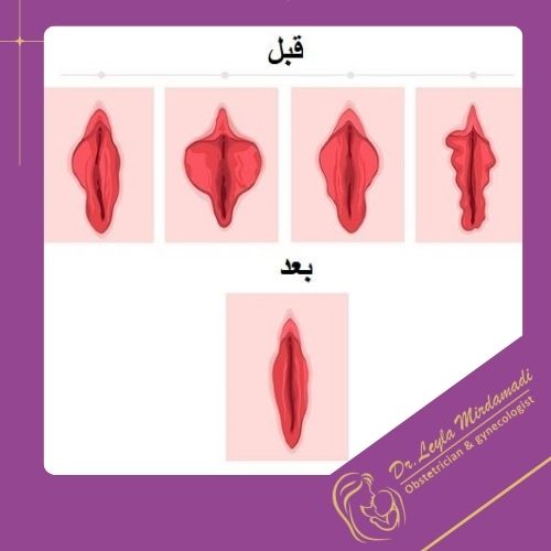 لابیاپلاستی چیست؟