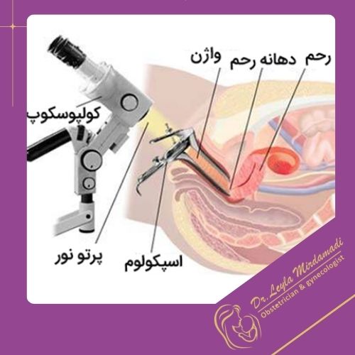 کولپوسکوپی چیست؟