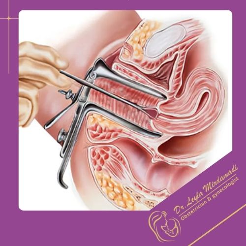 مراقبت‌های بعد از بررسی تخصصی دهانه رحم