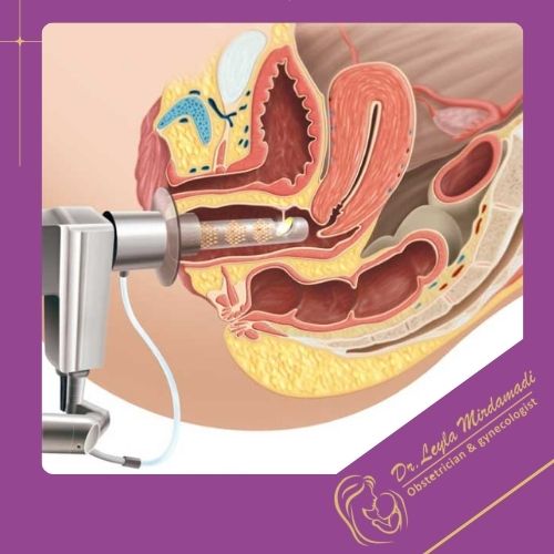 لیزر RF چیست و چگونه عمل می‌کند؟