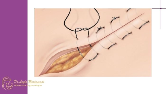 آیا باز شدن بخیه خطرناک است؟ آیا باز شدن بخیه خطرناک است؟