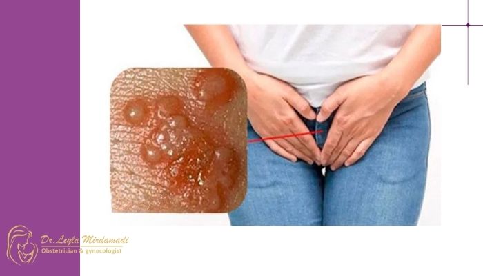 آیا پس از درمان ممکن است زگیل تناسلی دوباره برگردد؟