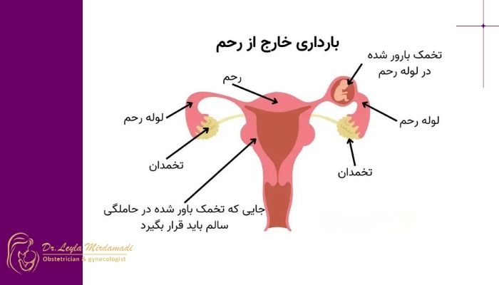 بارداری خارج از رحم چیست؟