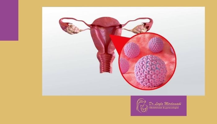 بهترین دکتر درمان HPV در شمال تهران (شیخ بهایی)
