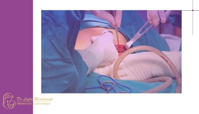 زایمان سزارین تا چند بار امکان ‌پذیر است؟