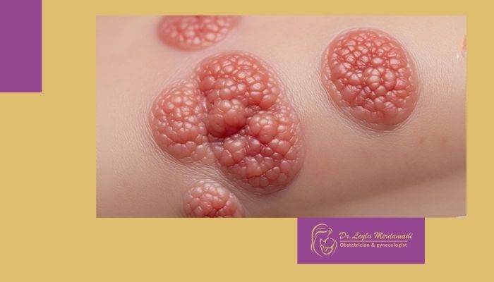 زگیل تناسلی بعد از چند وقت خوب می‌ شود؟ آنچه باید بدانید