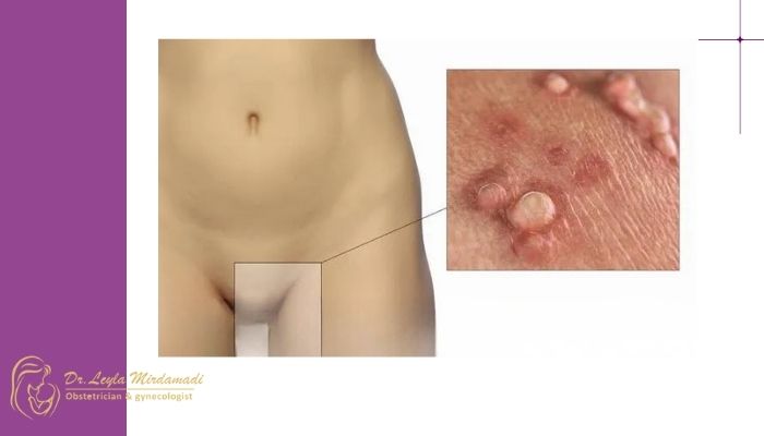 زگیل تناسلی بعد از چند وقت خوب می‌ شود؟