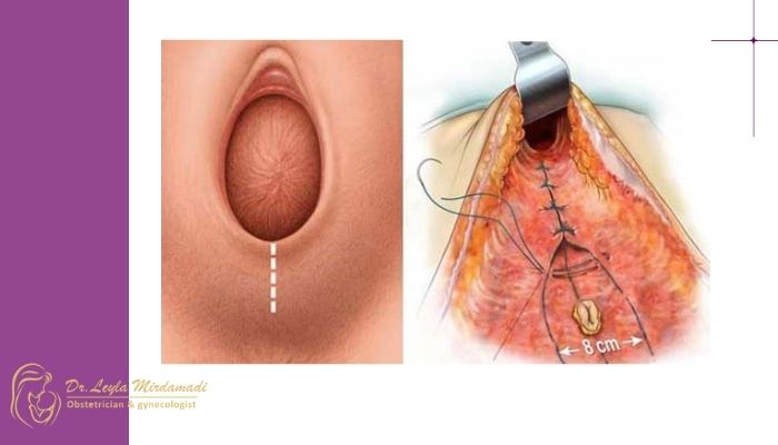چطور بفهمیم بخیه زایمان طبیعی خوب شده است؟ چطور بفهمیم بخیه زایمان طبیعی خوب شده است؟