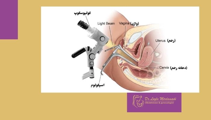 کولپوسکوپی چیست و چگونه انجام می شود؟ و بهترین دکتر برای انجام آن