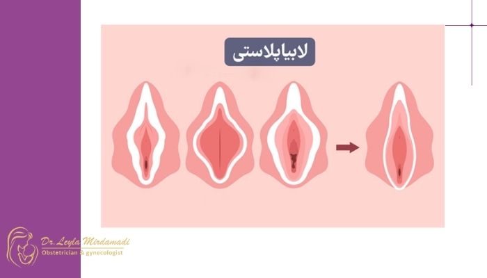 دوران نقاهت جراحی کوچک کردن لابیا دوران نقاهت جراحی کوچک کردن لابیا